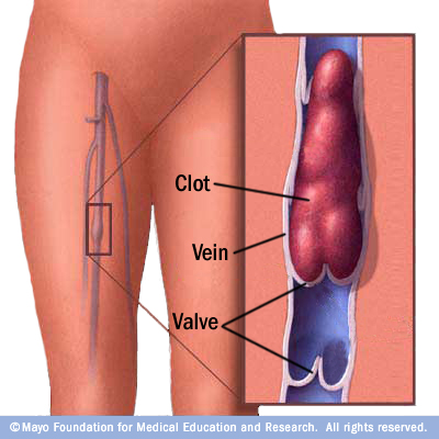 Video come a gambe di bendaggio a varicosity di gambe